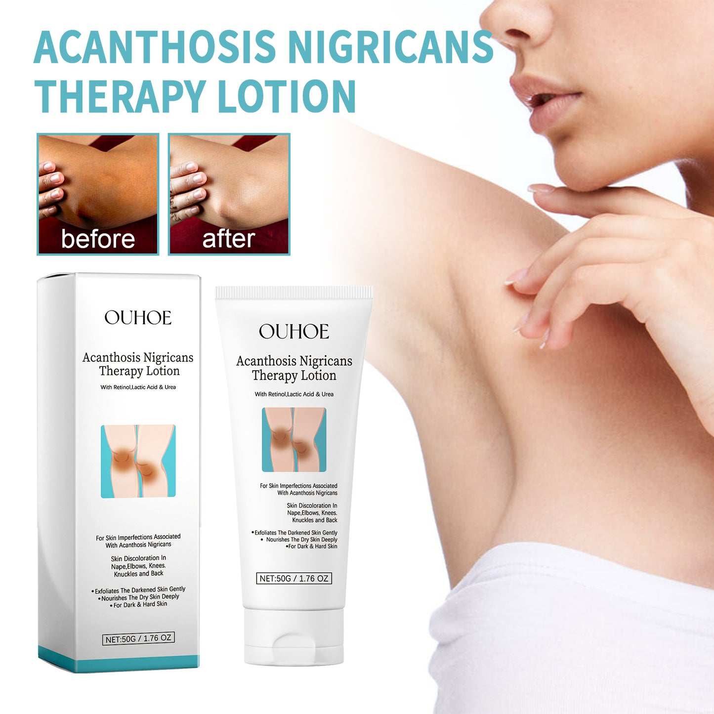 Acanthosis Nigricans Therapy Lotion - Dark Spot Corrector for Skin Repair