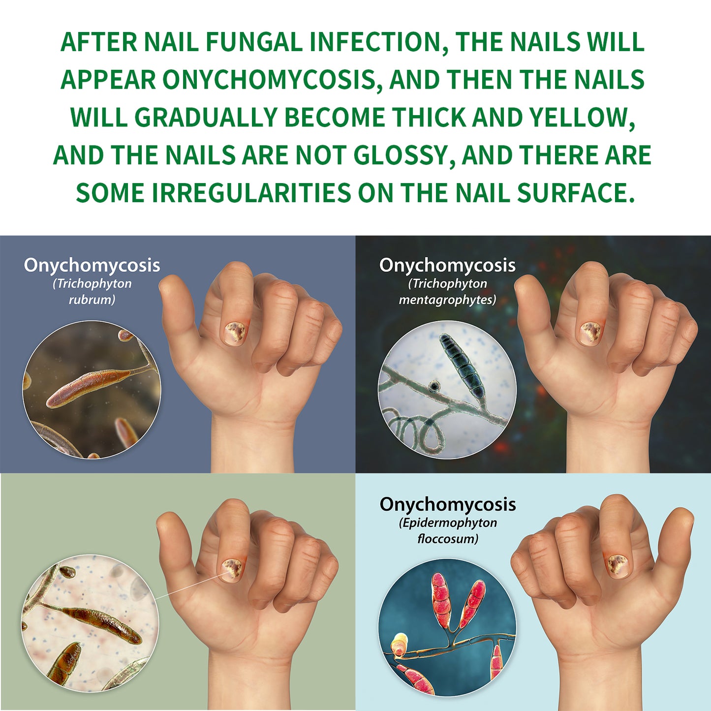 Ginger Nail Repair Solution for Fungal Treatment and Nail Restoration