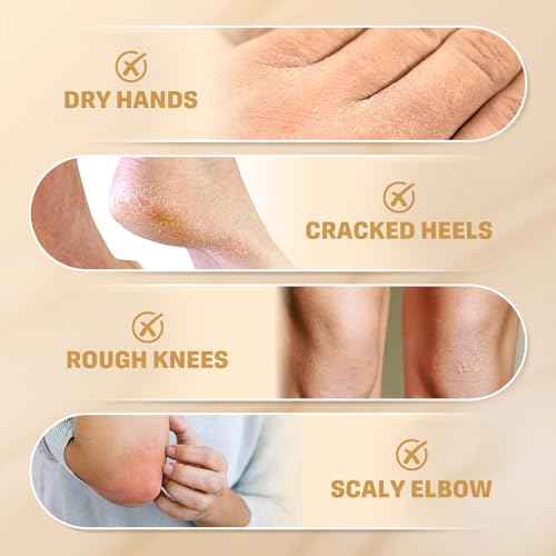 60% Urea Cream with 2% Salicylic Acid, Urea Cream 60 Percent for Feet & Hands- Maximum Strength Moisturizer for Rough, Dry, Thick & Cracked Skin, Callus Remover, Deep Hydration, 150g