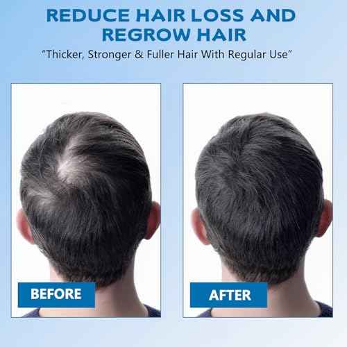 5% Minoxidil Foam for Men, Minoxidil for Women Hair Growth, Infused with Biotin, Hair Growth Treatment, Foam Hair Regrowth Treatment for Hair Thinning Receding Hairline,(2 oz Bottle), 3-Pack