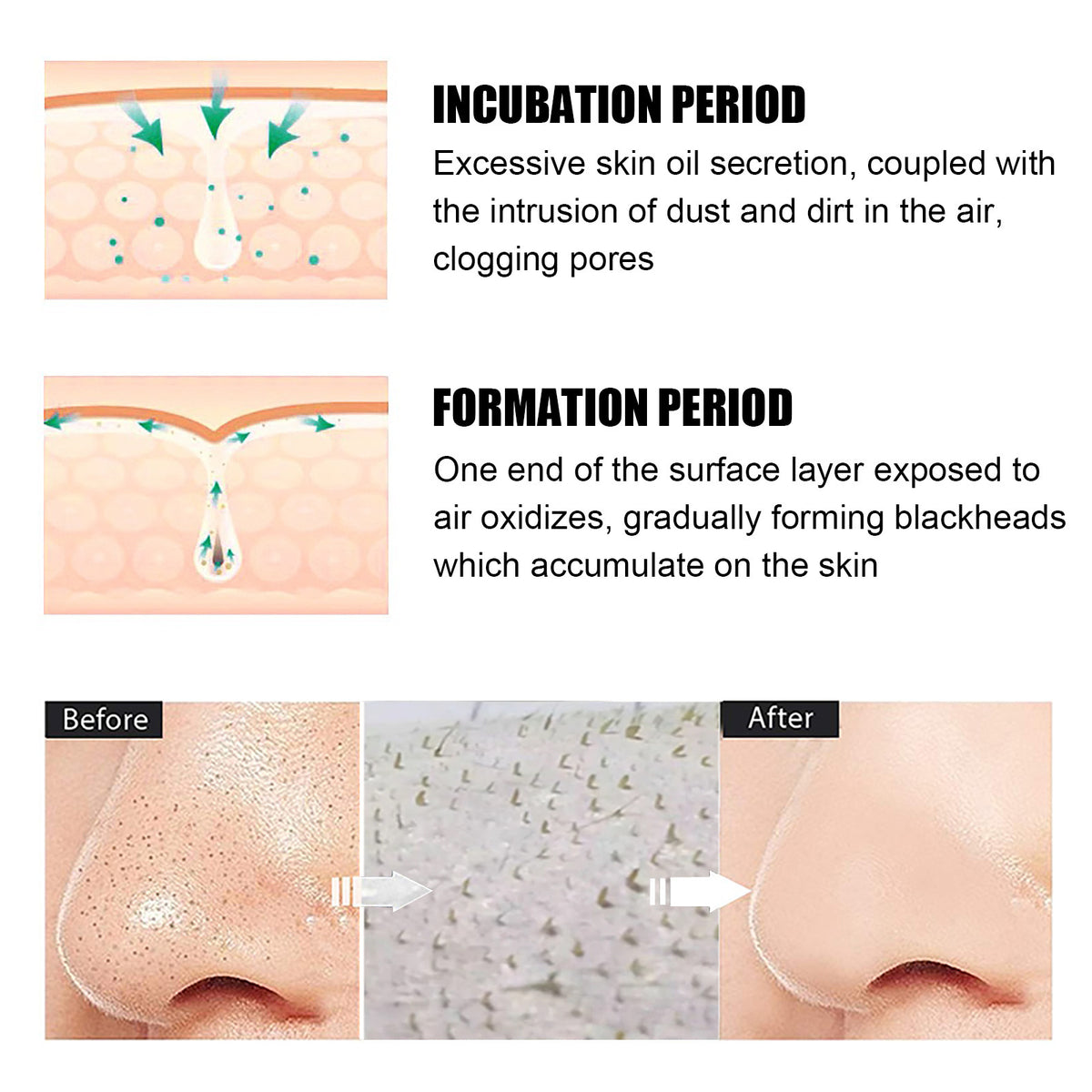Blackhead Removal Nose Patches - Deep Cleansing Pore Strips, 15g, 40PCS