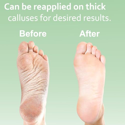 Dr. Entre's Callus Remover Gel: Extra Strength Callus Remover for Feet, Foot Callus Remover, Foot Care, Pedicure Tools Supplies, Dead Skin Remover, 4 oz