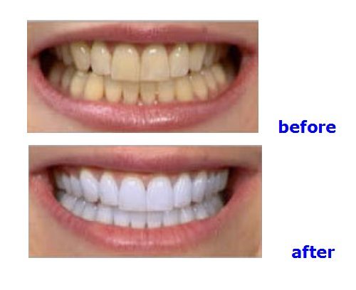 Professional De!ntal Portable Teeth Whitening Machine LED Bleaching Accelerator Light Lamp YS-TW-A