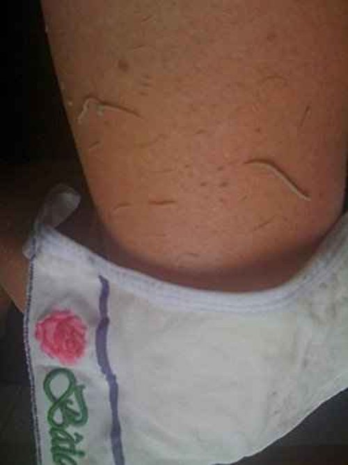 Baiden Exfoliator System-Best Firming Face Body & Back Scrub Mitts-Remove Blackheads, Dry Skin, Wrinkles, Cellulite, Controls Acne-Top Facial Lips Eyelids Treatment-Circulation and Collagen Boosting