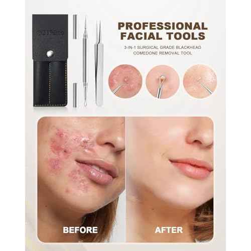 SGNEKOO Professional Facial Milia Removal Tool and Whitehead Extractor,Titanium Alloy Double Ended Needle and Steel Tweezers Kit,Blackhead,Blemish,Zit and Pimple Acne Remover Popper (Stainless Silver)