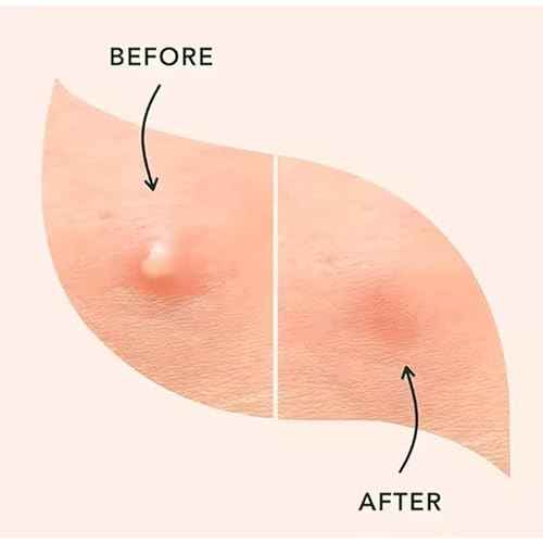 (5? Each) Pimple Patches 324 Pack - Hydrocolloid Acne Patches with Salicylic Acid & Tea Tree Oil - 4 Sizes S/M/L/XL - Face Acne Treatment - Easy Peel Perforated Sheets