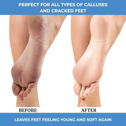 ForPro Professional Collection Advanced Callus Eliminator Gel, Professional Grade, No Drip Callus Remover Gel for Feet, 8 oz.