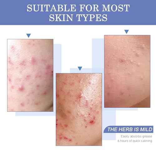 invisible pimple patches for face - acne patches, zit patches, Spot Stickers with Tea Tree and Salicylic Acid£¬4 Sizes (8mm, 10mm, 12mm & 14mm)£¬220 Count