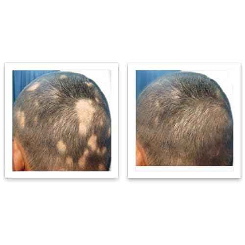 Caboki 10X Volumizing Hair Powder for Thinning Hair: Root Touch Up for Men and Women, Fill in Hairline & Edges, Cover Bald Spots. TALC-Free, Dark Gray