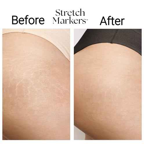 StretchMarkers Therapy Stretch Mark Cream ? Visibly Reduces and Treats, Stretch Marks Removal with Retinol, Hyaluronic Acid, Bioactive Peptides & 3D Stem Cell Technology, 1 fl oz