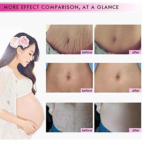Mango Stretch Marks and Scar Cream, Stretch Mark and Scar Removal Cream for Pregnancy, Belly Creams for Wrinkles, Obesity Fat Marks Scars Moisturizing, Remove Marks (40g)