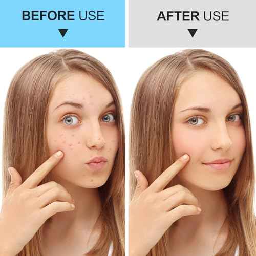 Pimple Popper Tool Kit Blackhead Remover Tools (5 Piece Kit), Professional Stainless Black Head Remover for face, Risk Free Treatment Pimple Extractor with Tweezers