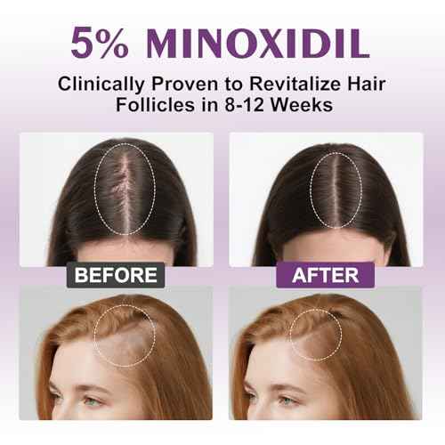5% Minoxidil Spray for Women-4 PCS £¬monoxide for men hair Infused with Biotin, hers hair regrowth treatment, Supports Thicker and Fuller Hair & Beard (13oz, 7 Month Supply)