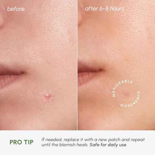 MAREE Invisible Pimple Patches - Clear Pimple Patches for Face - Hydrocolloid Acne Patches Anti Blemish - Zit Stickers for Face - Parches Para Acne - Pinple Zit Patches Pimple Stickers - 72 Dots