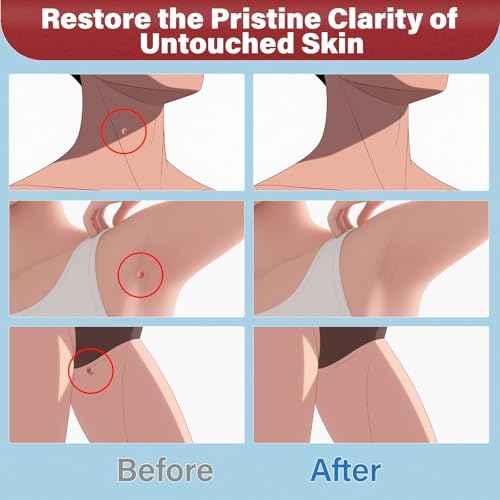 Goodnites Skin Tag Remover, Fast-Acting Gentle Salicylic Acid Formula Skin Tag Removal, Suitable for Neck, Underarms, Groin, Trusted by The Whole Family, 1 PCS