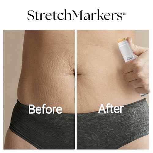 StretchMarkers Therapy Stretch Mark Cream ? Visibly Reduces and Treats, Stretch Marks Removal with Retinol, Hyaluronic Acid, Bioactive Peptides & 3D Stem Cell Technology, 1 fl oz