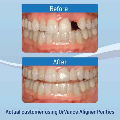 OrVance Aligner Pontics - Original (Medium) Shade (16 Count) | Temporary Tooth Replacement for Invisalign, Aligner Trays and Clear Retainers During Orthodontic Treatment
