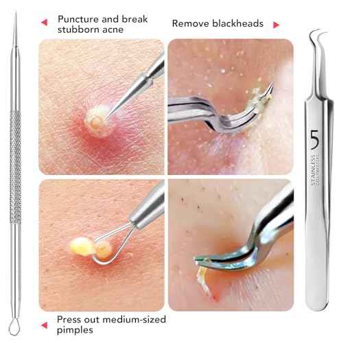 Litbear 6 Pcs Blackhead Remover Tools,Pimple Popper Tool Kit,Blackhead Pimple Comedones Extractor,Acne Tools Extractor kit, Scraper for Face Nose Deep Cleansing with Leather Case