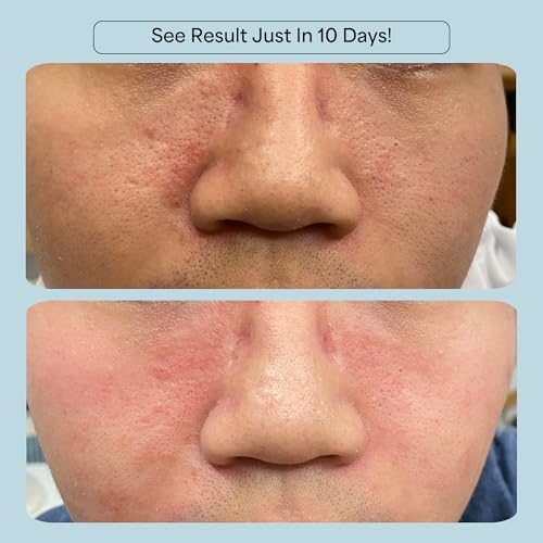 CelRevive B-Restore¢â Barrier Cream soothes, hydrates, and supports microbiome balance, restoring comfort to sensitive, dry skin. EWG Verified¢â for safety and transparency. Made in Australia