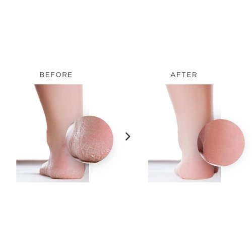 nu119 How to Get Soft Feet | Foot Care Kit Includes 120ml Instant Foot Peel Spray for Calluses Removal, Softening Balm & File | Professional Products to Make Your Feet Soft