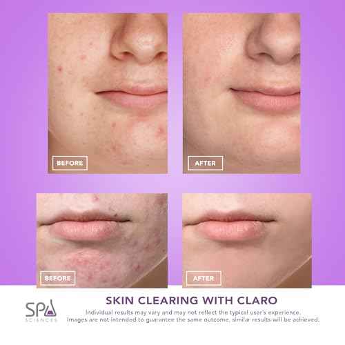 Spa Sciences CLARO Clinically Proven Blue & Red LED Acne Treatment Light Therapy System-FDA Cleared-Rechargeable- Professional Home Acne Healing/Clearing Treatment