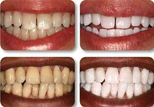 Ultra White 16% Teeth Whitening Gel Large 5 Tubes of Gel