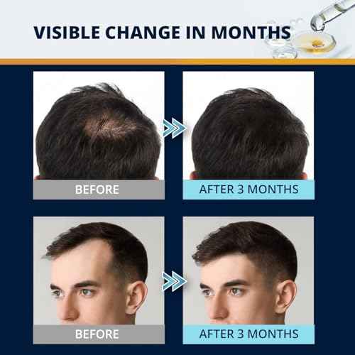 5% Minoxidil Hair and Beard Growth Kit: Extra Strength Minoxidil Topical Hair Regrowth Treatments Serum for Thinning Hair - Hair Loss Products for Men and Women