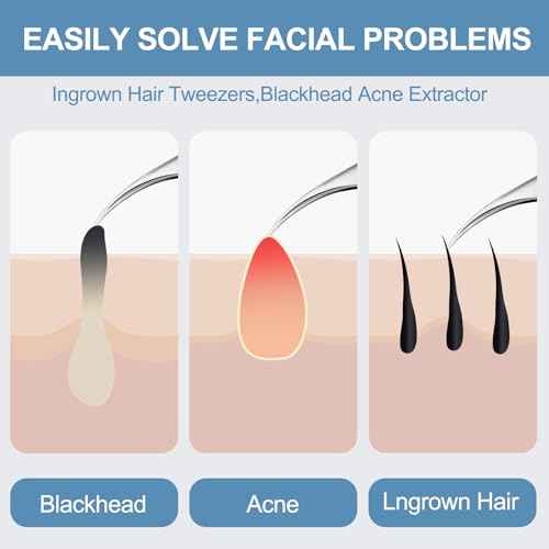 60PCS Dual Heads Blackhead Remover, Pimple Comedone Extractor, Acne Whitehead Blemish Removal Kit, Premium Stainless Steel Pimple Popper Tool kit, Risk Free for Face Skin, with Portable Box