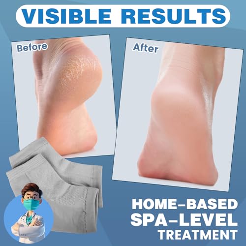 Moisturizing Heel Socks - 6 Pairs for Dry Cracked Feet, Toeless Gel Socks for Hydration and Repair