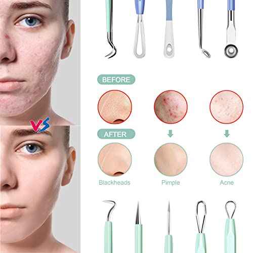 Blackhead Remover Tools MENOLY 10Pcs Pimple Popper Tool Kit, Blackhead Remover Extractor Tools, Acne Kit for Blackhead,Blemish,Zit Whitehead and Comedone Extractor Tool with Leather Bag