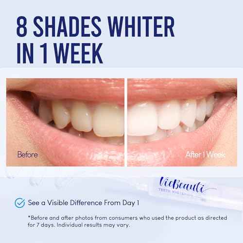 VieBeauti Teeth Whitening Kit with LED Light for Sensitive Teeth, 35% Carbamide Peroxide, Remineralizing Gel for Fast Results Mint