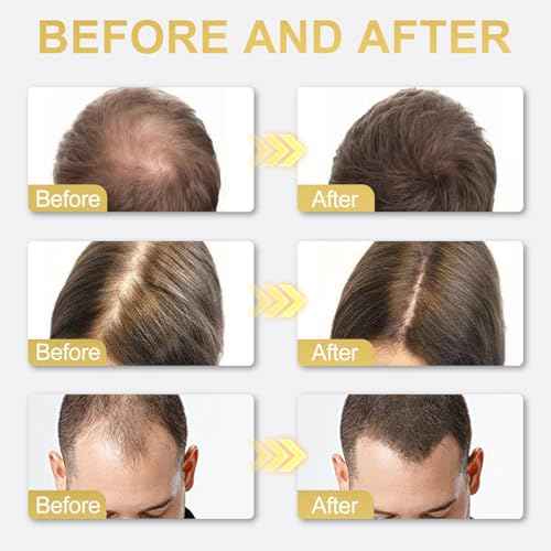 5% Minoxidil Hair Growth Serum for Men and Women, for Hair and Beard Regrowth Treatment - 30ml