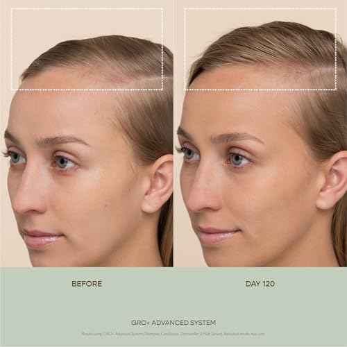 VEGAMOUR GRO+ Advanced Dermaroller | 1,200 Microneedle 0.25mm Scalp Tool | Gently Exfoliates the Scalp | Wide Head for Maximum Coverage