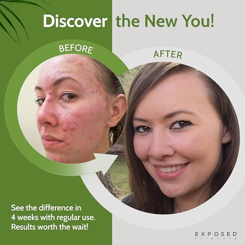 Exposed Skin Care, Basic Acne Treatment Kit with 2.5% Salicylic Acid and 3.5% Benzoyl Peroxide to Clear Up Teen, Adult, Hormonal and Cystic Acne ? Natural, Non-toxic and Cruelty Free