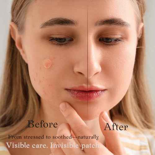 Dot by Nouf Acne Patch & Pimple Patches Fast Overnight Spot Treatment with Salicylic Acid & Tea Tree Oil Invisible Hydrocolloid, Ultra-Thin, Gentle 36 Count for Clear Skin