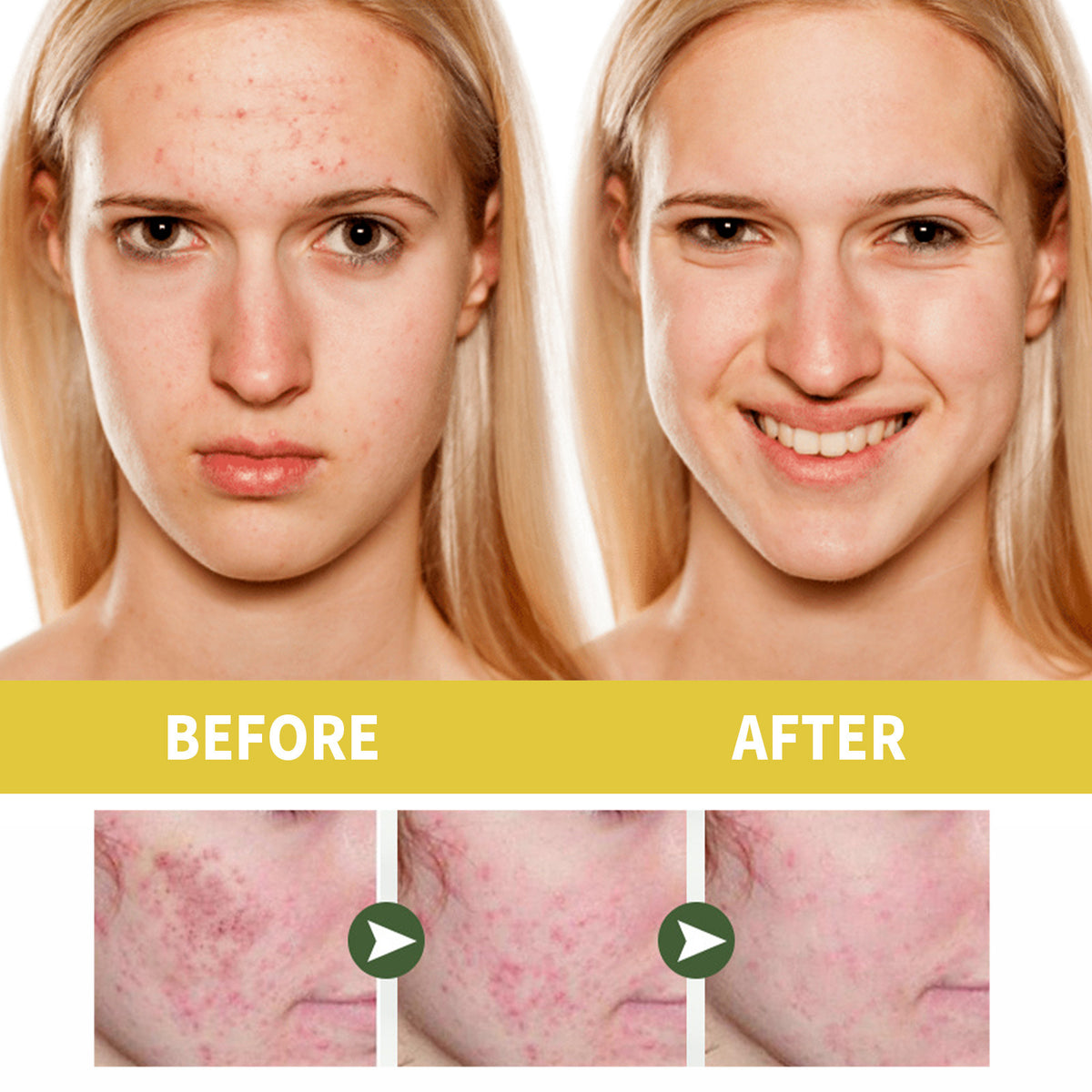 Acne Treatment Oil for Facial Cleansing & Brightening - 30ml