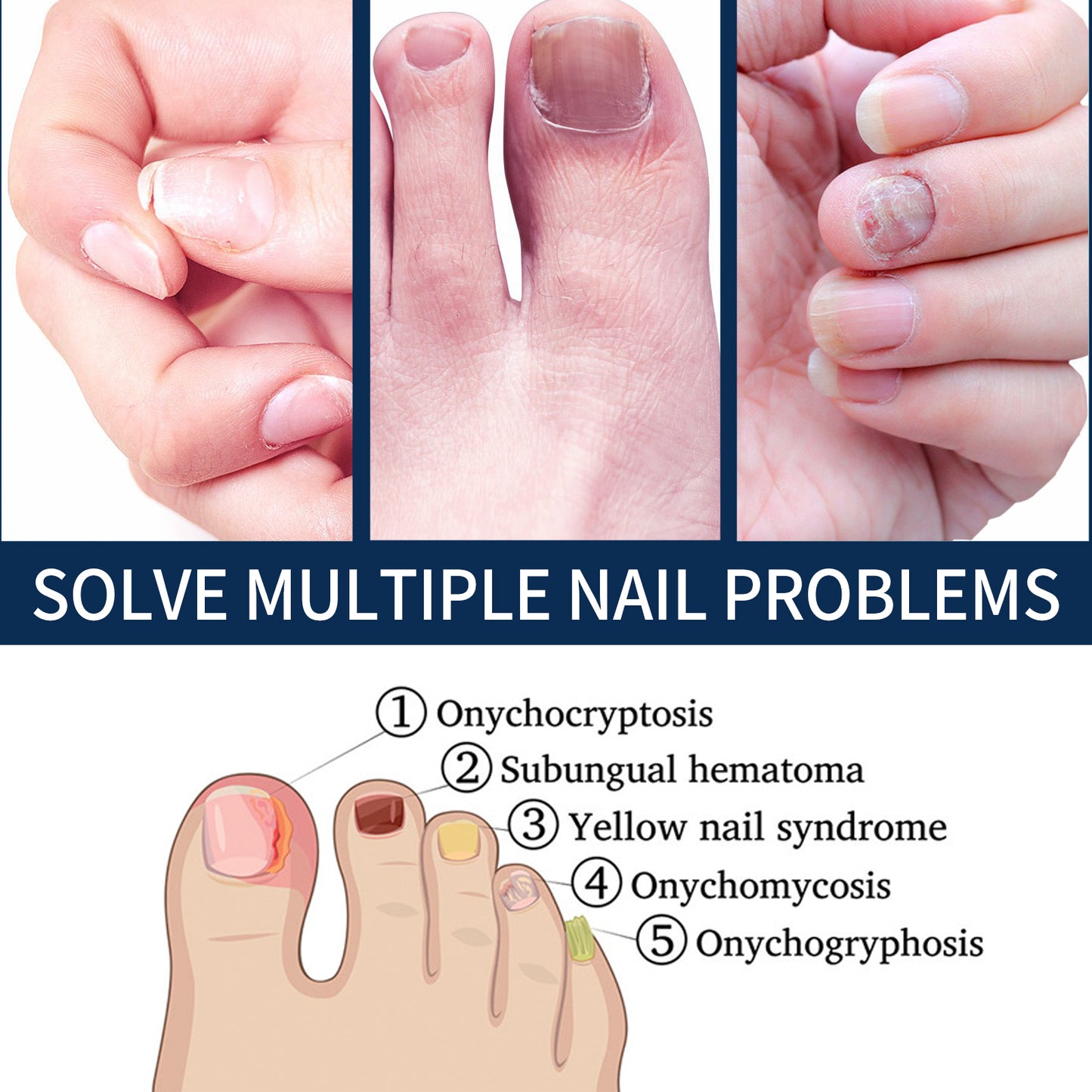 Nail Repair Essence Pen - Moisturizing Nail Treatment for Damaged Nails