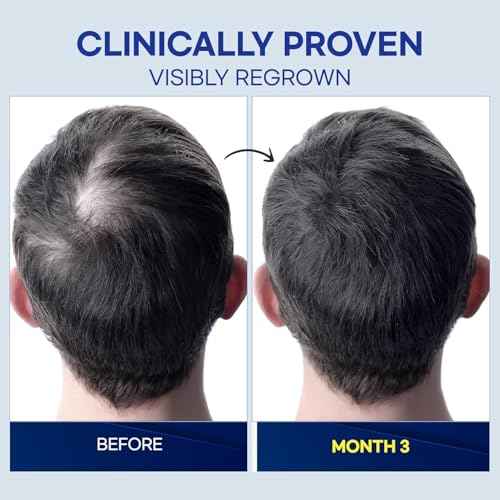 ProBliva 5% Minoxidil for Men Spray: Extra Strength 5% Minoxidil Topical Hair Growth Treatment - Clinically Proven Solution for Hair Loss & Thinning - Made in USA (2 Fl Oz (Pack of 1))