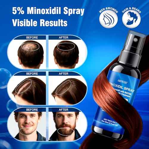 5% Minoxidil Spray for Men and Women,Infused with Biotin, Hair Growth Treatment,Topical hair growth serum,Supports Thicker and Fuller Hair & Beard (6 Pcs,12 Fl Oz Total,6 Month Supply)