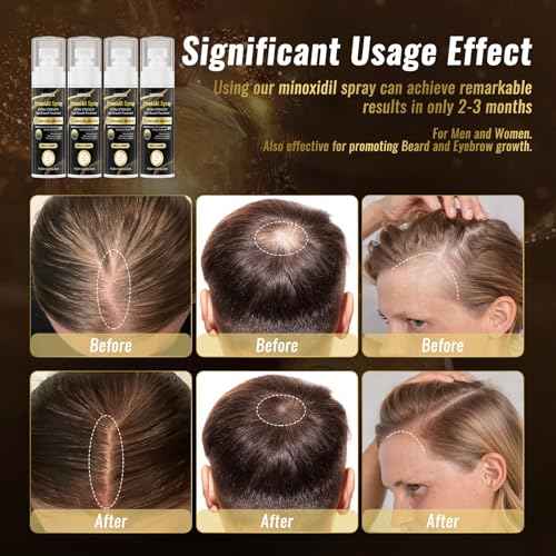 5% Minoxidil Spray for Men & Women (4 Month Supply)-Extra Strength Hair Growth Spray with Biotin & Castor Oil,Clinically Proven for Thinning Hair & Beard Regrowth, Non-Greasy Formula 4 pack£¨8.12 oz)