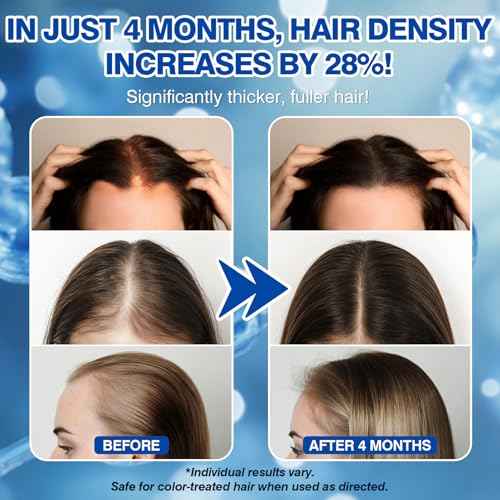 5% Minoxidil for Women Hair Growth Spray Serum Topical Minoxidil Hair Regrowth Thicker Prevent Hair Loss for Thickening Longer Fuller Healthier Hair 3 Bottles of 2oz