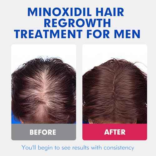 5% Minoxidil for Men, Extra Strength Hair Growth Serum, Beard Growth Oil, Fast Absorbing Dropper, Non Greasy, Low Residue Formula, 2-Pack for 2 Months, Hair Regrowth Treatment for Thinning Hair