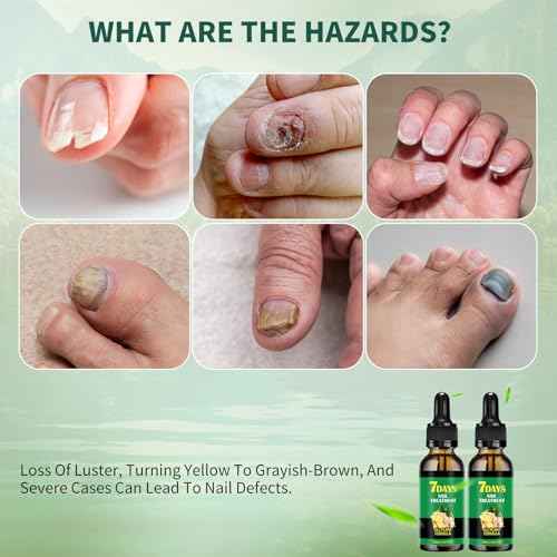 Ginger nail treatment 7 days nail support nail care, 2 pcs nail treatment, Ginger nail growth serum, Ginger cuticle care oil for nails,Cuticle serum for nails