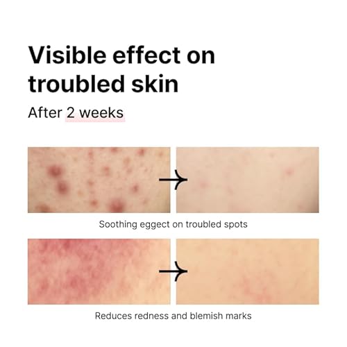 PINKWONDER Tamanu Hero Mineral Salt Essence Toner | All-in-One Blemish Solution | Instant Cooling & Redness Relief | Tamanu Oil & 70+ Minerals for Skin Balance (150ml / 5.07 fl. oz.)