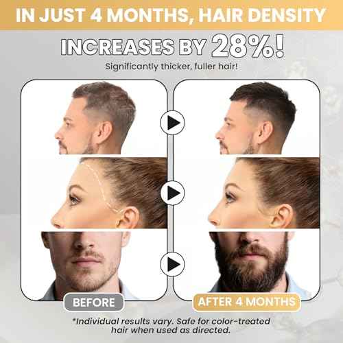 5% Minoxidil Hair Growth Serum Minoxidil Biotin for Hair Beard Growth Prevent Hair Loss for Thicker Longer Fuller Healthier Hair Men and Wome 3 Bottles of 2oz