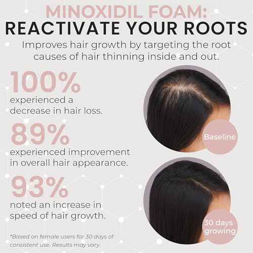 Minoxidil for Women | 5% Minoxidil For Women Hair Growth | Hair Regrowth Treatment | Unscented Topical Foam | Dermatologist Recommended | Clinically Proven Formula | 3 Month Supply