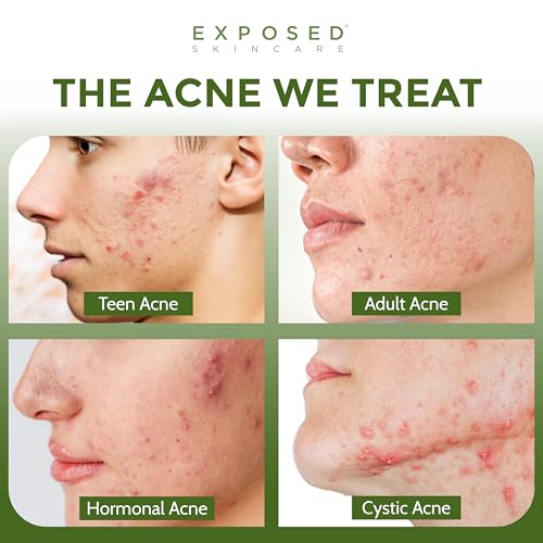 Exposed Skin Care, Basic Acne Treatment Kit with 2.5% Salicylic Acid and 3.5% Benzoyl Peroxide to Clear Up Teen, Adult, Hormonal and Cystic Acne ? Natural, Non-toxic and Cruelty Free