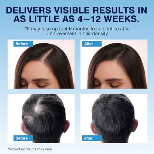 5% Minoxidil Foam? Hair Regrowth Treatment for Men & Women, Prevents Hair Thinning & Strengthens Roots, Minoxidil Foam for Fuller, Healthier Hair