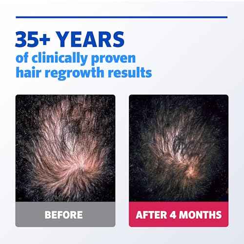 Men's Rogaine Extra Strength 5% Minoxidil Topical Solution for Hair Loss & Regrowth, Topical Treatment for Men, Unscented Minoxidil Follicle Booster Liquid, 1-Month Supply, 2 fl. oz