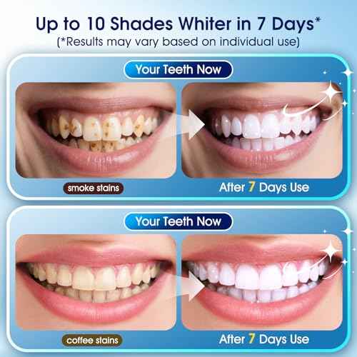 Teeth Whitening Kit ? 3 Teeth Whitening Pens + 2 Desensitizing Pens ? LED Light ? 35% Carbamide Peroxide ? Safe & Dentist-Recommended ? Fast 7-Day Visible Whitening + Remineralizing Care